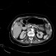 IPMN, intrapapillary mucinous neoplasm, central type, colitis: CT - Computed tomography